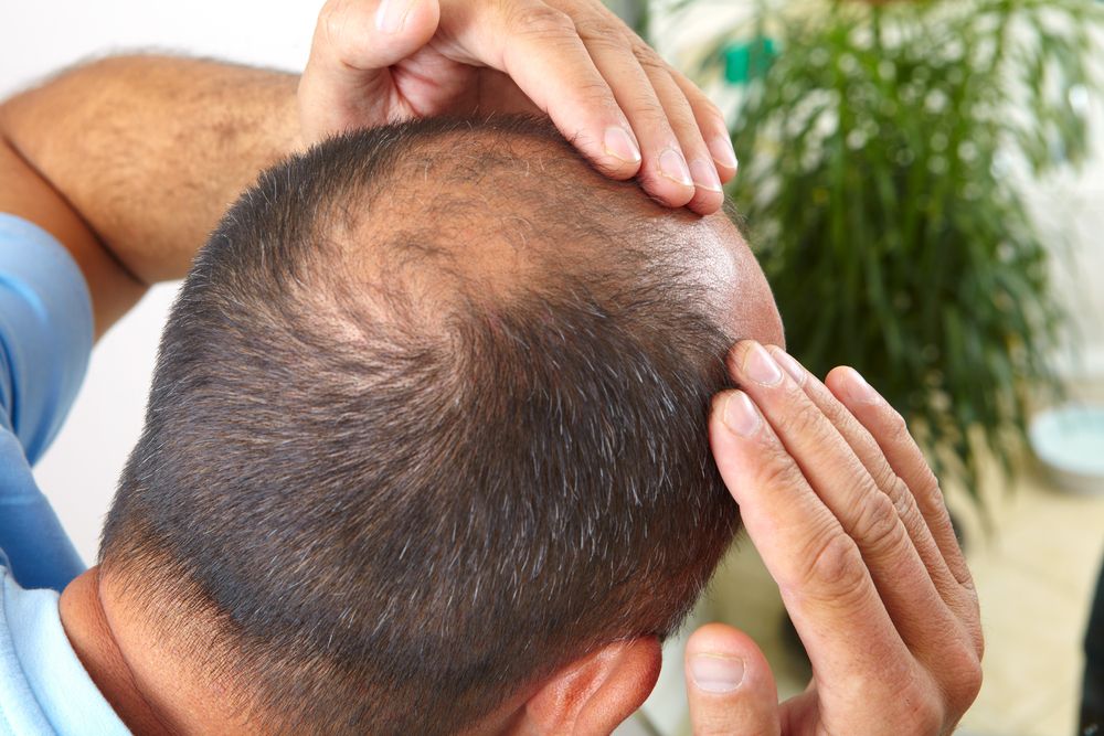 زراعة الشعر في إسطنبول