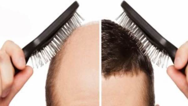 Hair transplantation in Turkey