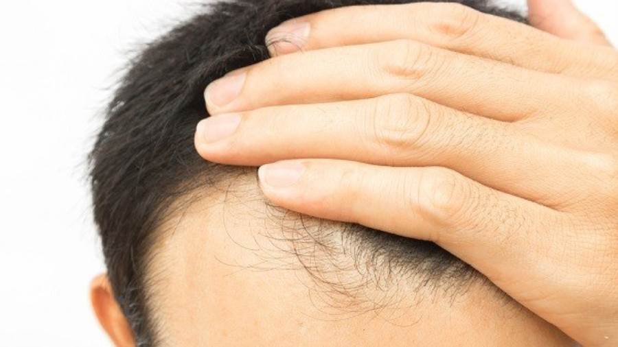 Hair transplantation in Turkey