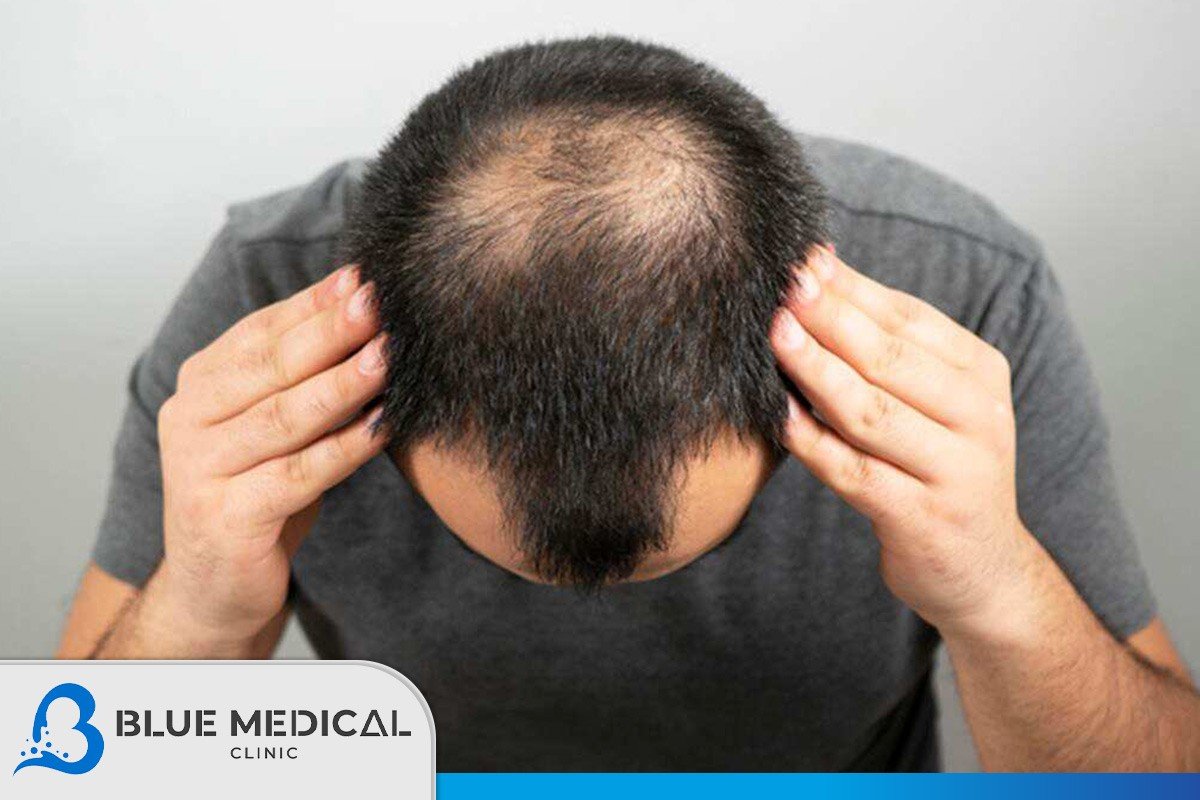 What Is Hair Transplant  Procedure Cost Side Effects  Medlinks