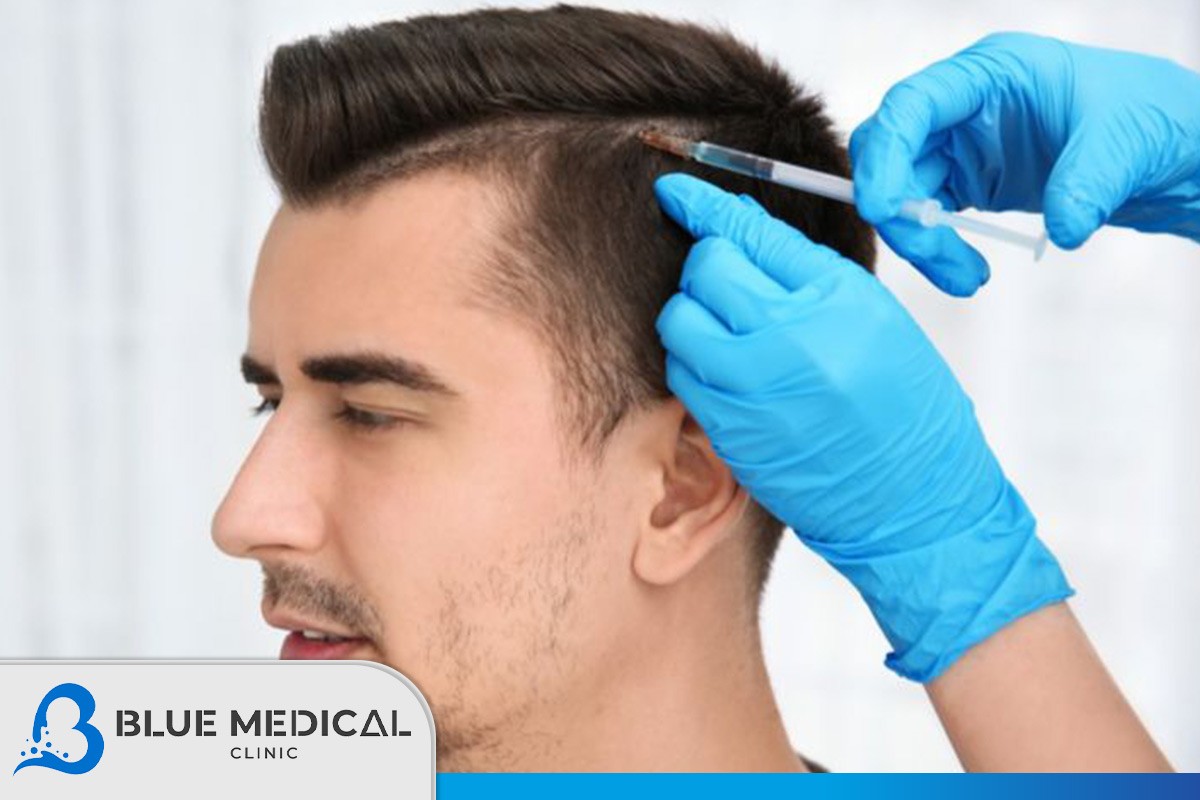 زراعة-الشعر-في-تركيا-بتقنية-الاقتطاف--FUE