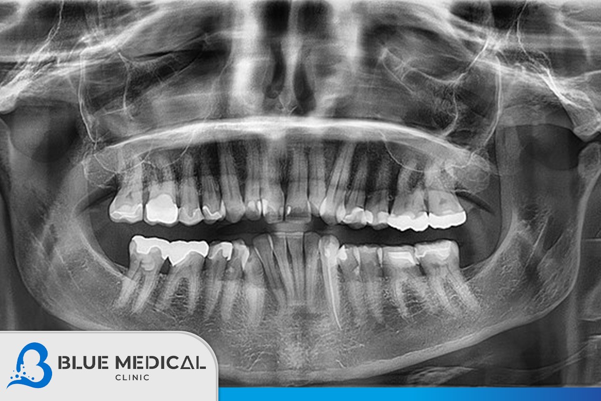 ما-الهدف-من-استخدام-أشعة-الأسنان؟