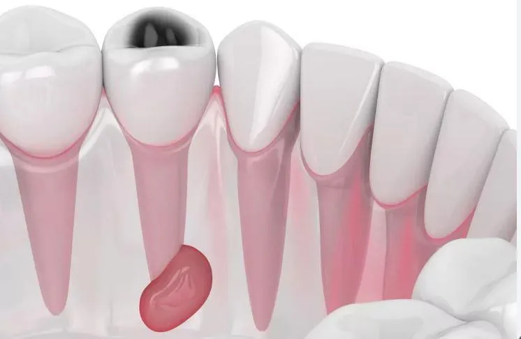 tooth abscess